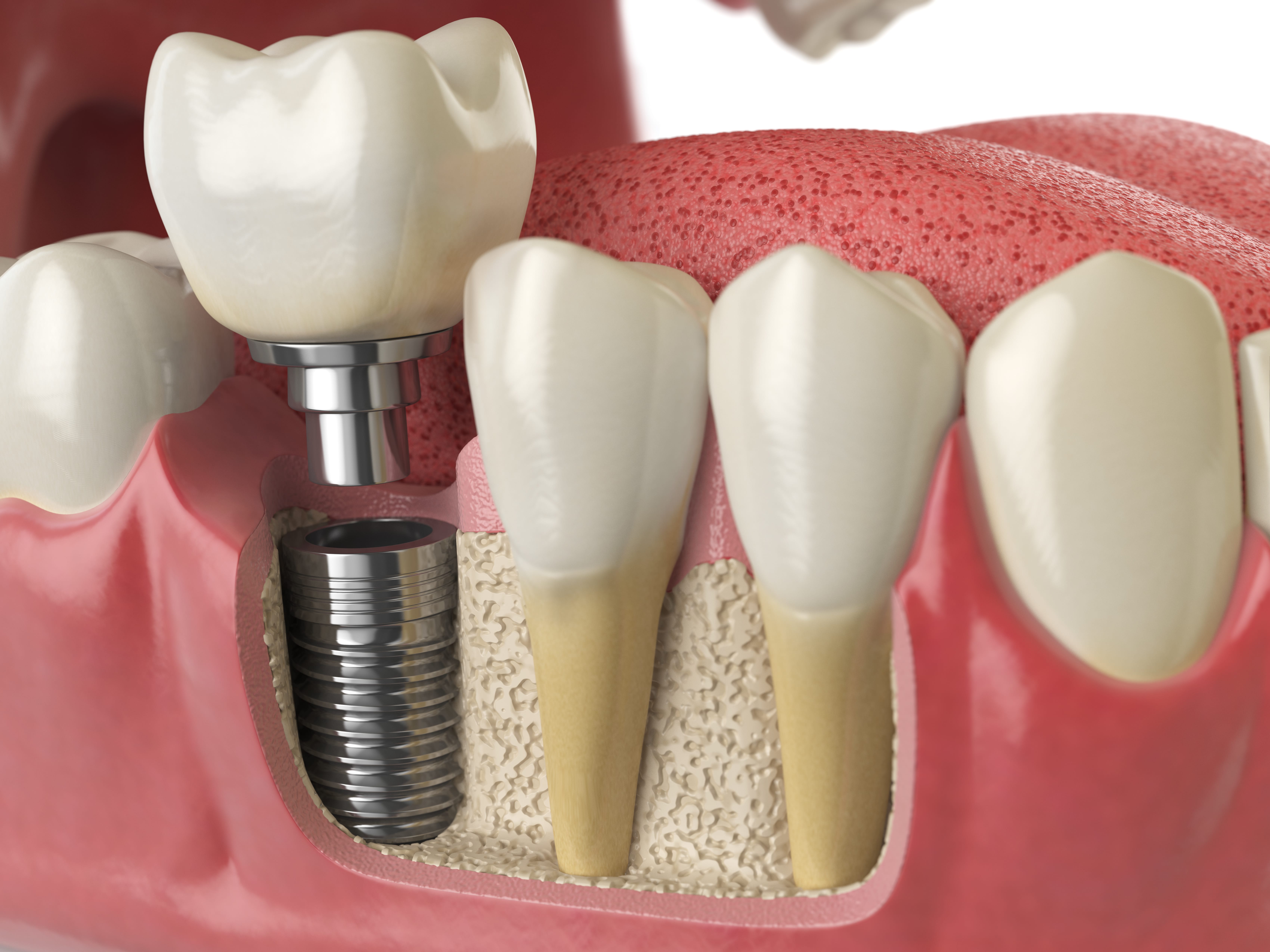 Dental Implants in Ahmedabad